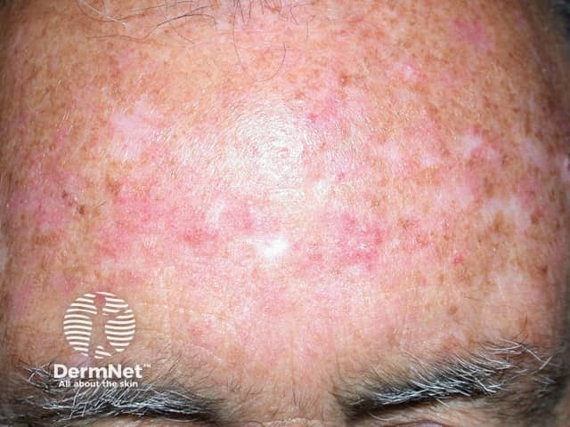 Actinic Keratoses treated with imiquimod