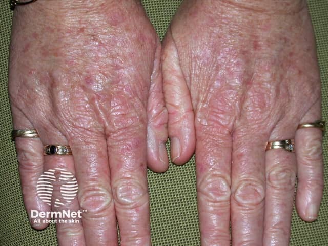 Actinic Keratoses treated with imiquimod