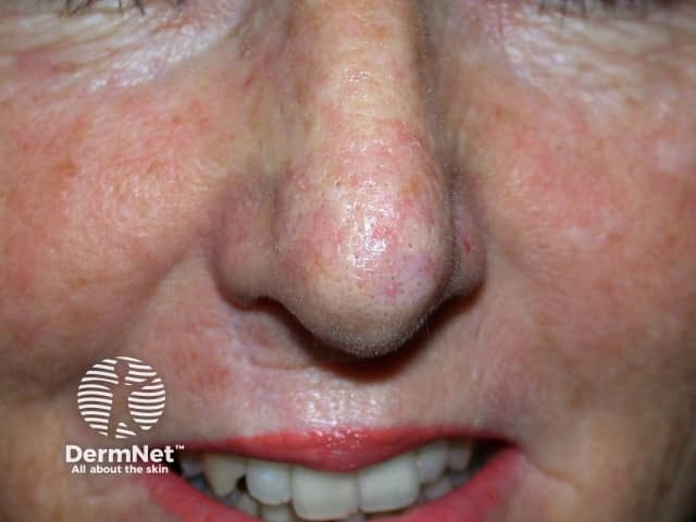 Actinic Keratoses treated with imiquimod