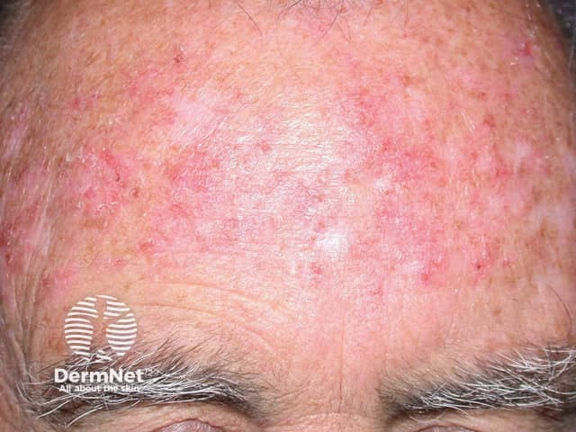 Actinic Keratoses treated with imiquimod