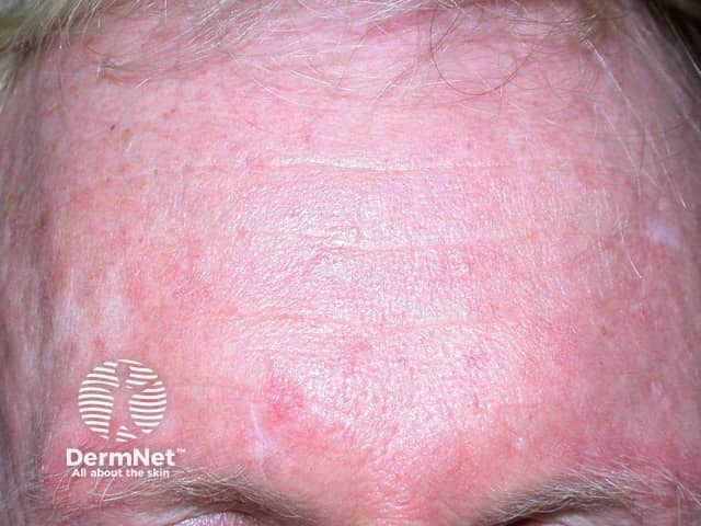 Actinic Keratoses treated with imiquimod