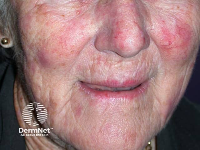 Actinic Keratoses treated with imiquimod