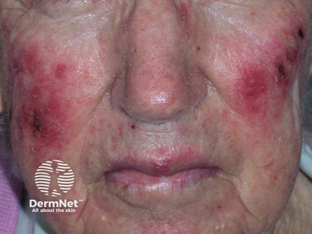 Actinic Keratoses treated with imiquimod