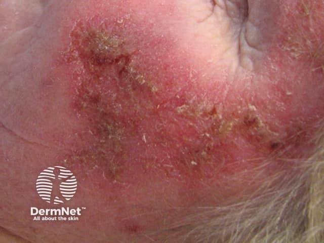 Actinic Keratoses treated with imiquimod