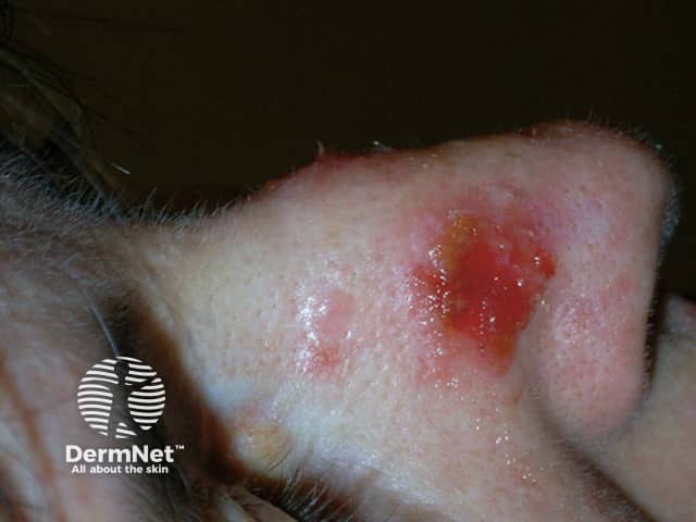 Actinic Keratoses treated with imiquimod