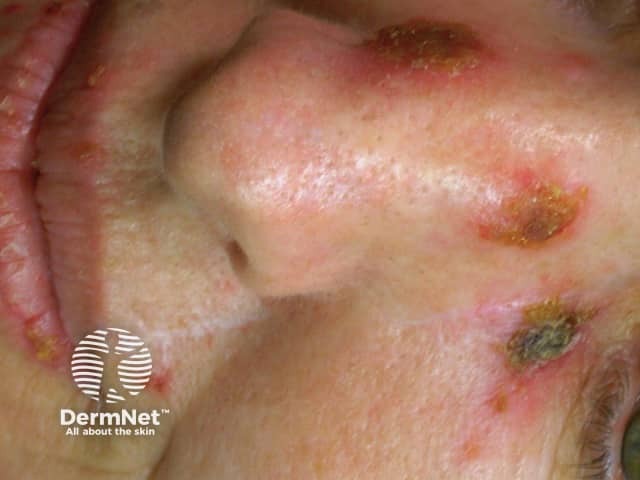 Actinic Keratoses treated with imiquimod