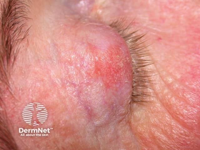 Actinic Keratoses treated with imiquimod