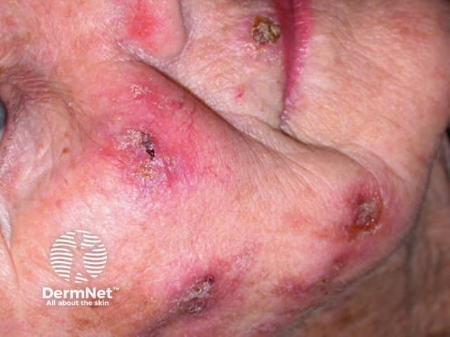 Actinic Keratoses treated with imiquimod