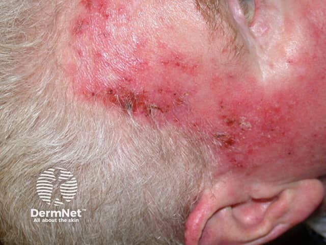 Actinic Keratoses treated with imiquimod