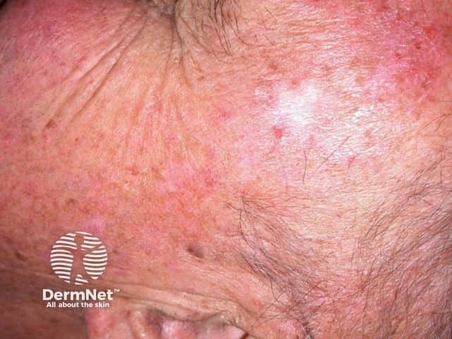 Actinic Keratoses treated with imiquimod