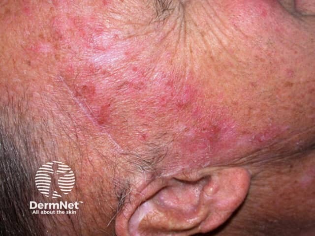 Actinic Keratoses treated with imiquimod