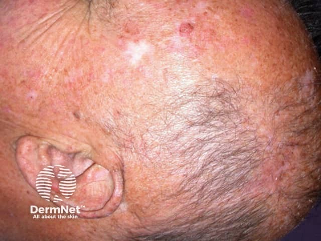 Actinic Keratoses treated with imiquimod