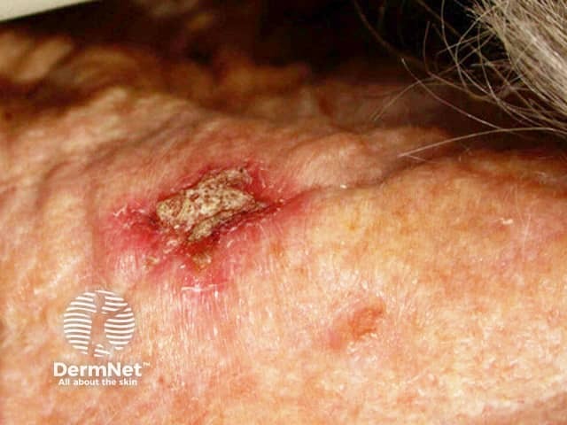 Actinic Keratoses treated with imiquimod