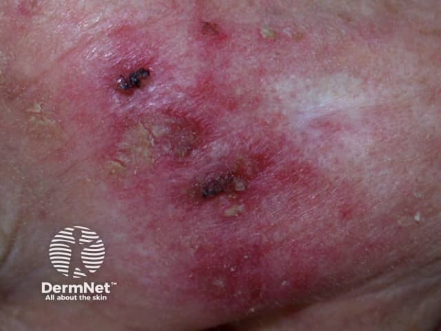 Actinic Keratoses treated with imiquimod