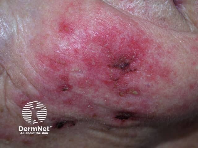 Actinic Keratoses treated with imiquimod