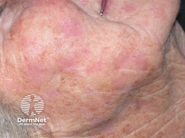 Actinic Keratoses treated with imiquimod