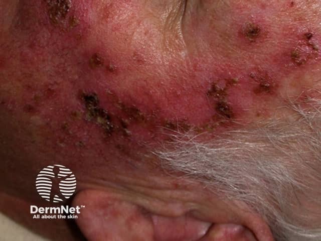 Actinic Keratoses treated with imiquimod