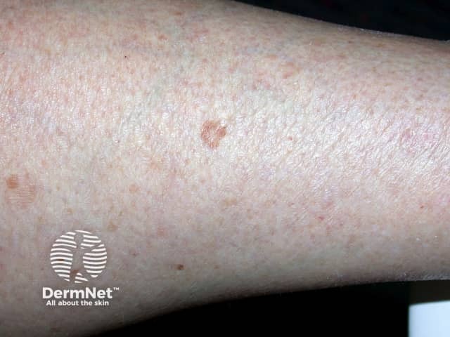 Actinic keratoses affecting the legs and feet