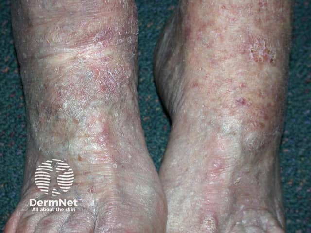 Actinic Keratoses affecting the legs and feet