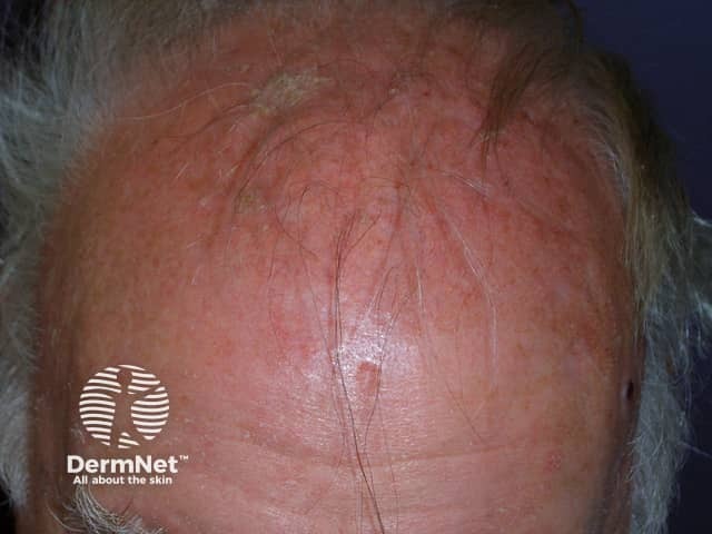 Actinic keratoses affecting the scalp