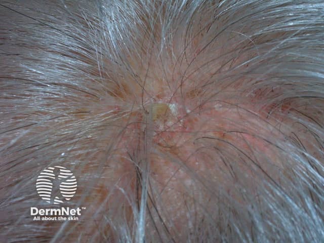 Actinic keratoses affecting the scalp