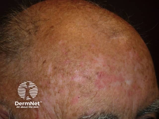 Actinic keratoses affecting the scalp