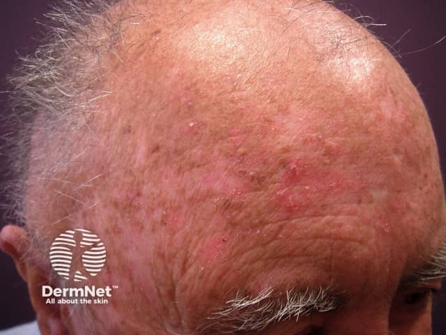 Actinic keratoses affecting the scalp