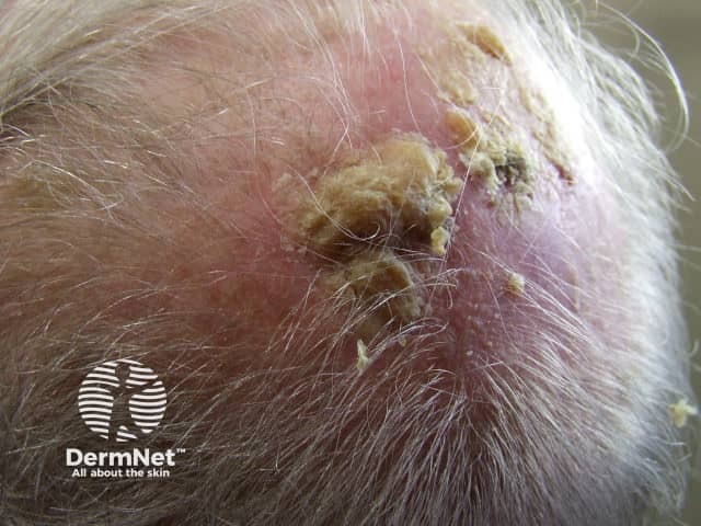 Actinic keratoses affecting the scalp