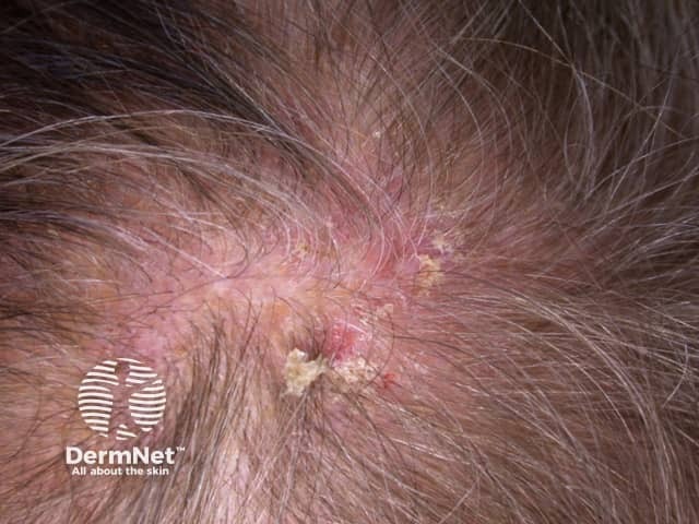 Actinic keratoses affecting the scalp