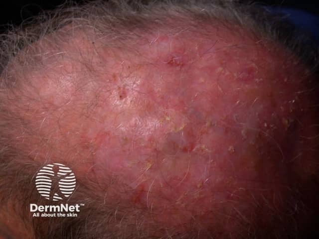 Actinic keratoses affecting the scalp