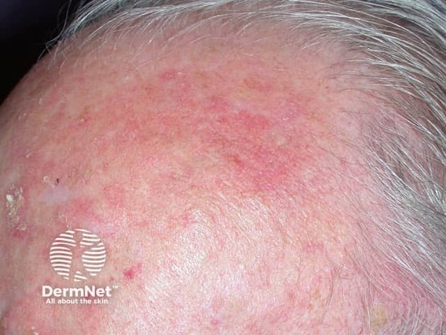 Actinic keratoses affecting the scalp