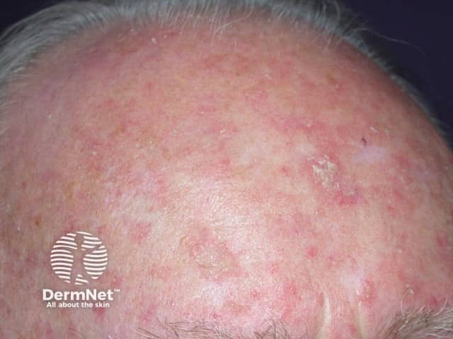 Actinic keratoses affecting the scalp