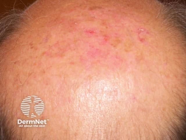 Actinic keratoses affecting the scalp