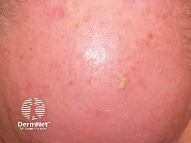 Actinic keratoses affecting the scalp