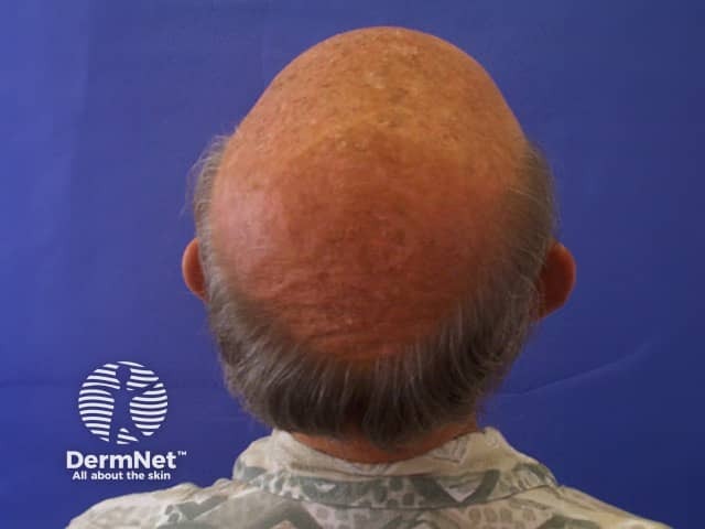 Actinic keratoses affecting the scalp