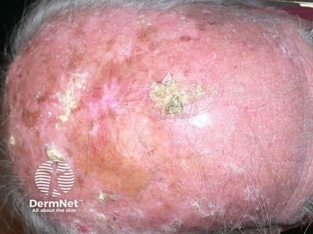 Actinic keratoses affecting the scalp