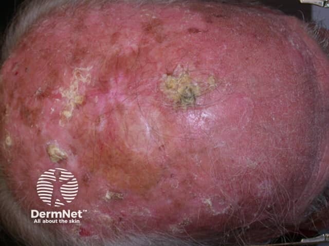 Actinic keratoses affecting the scalp