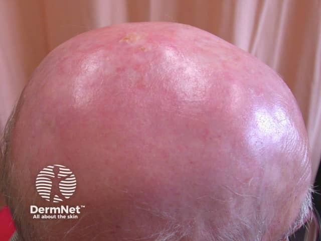 Actinic keratoses affecting the scalp