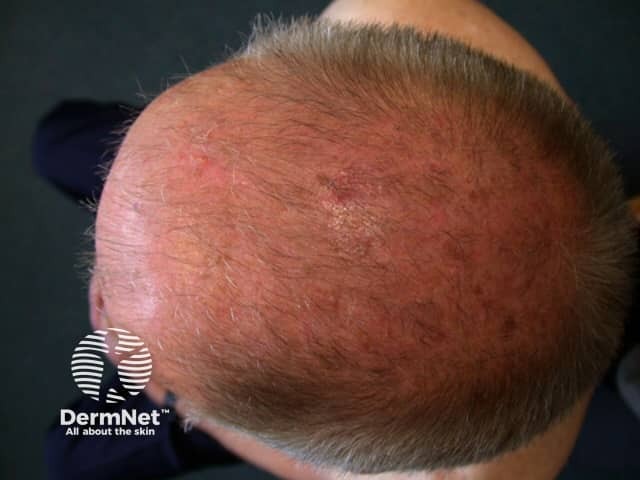 Actinic keratoses affecting the scalp