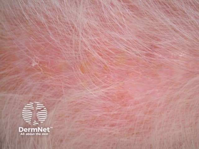 Actinic keratoses affecting the scalp