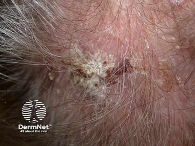 Actinic keratoses affecting the scalp