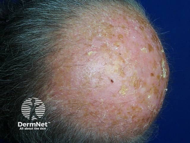 Actinic keratoses affecting the scalp