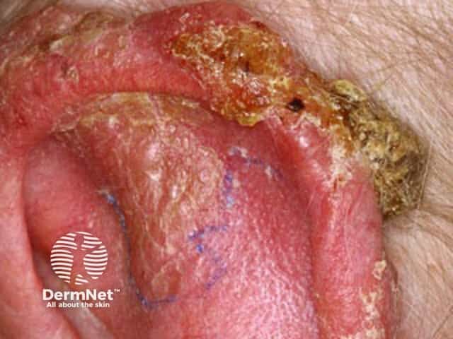 Basal cell carcinoma affecting the ear