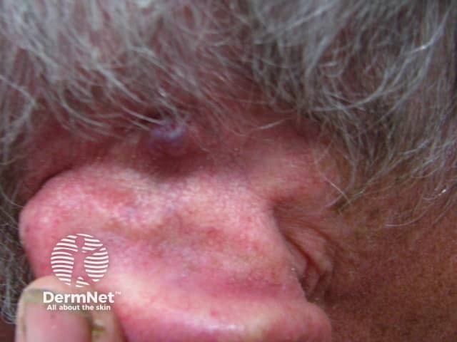 Basal cell carcinoma affecting the ear