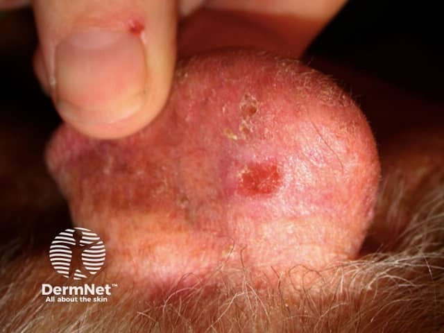 Basal cell carcinoma affecting the ear