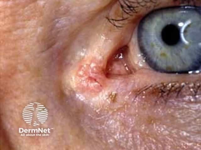 Basal cell carcinoma affecting the eyelid