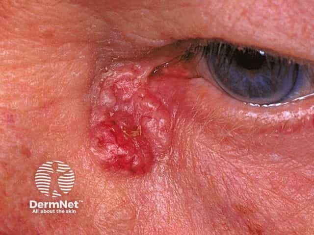 Basal cell carcinoma affecting the eyelid