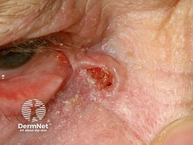 Basal cell carcinoma affecting the eyelid