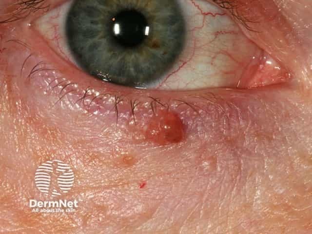 Basal cell carcinoma affecting the eyelid