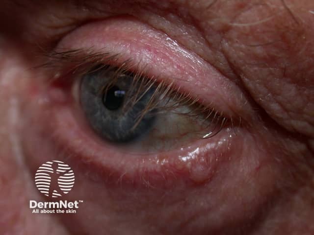 Basal cell carcinoma affecting the eyelid